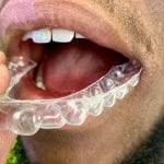 common bite problems within orthodontic treatment