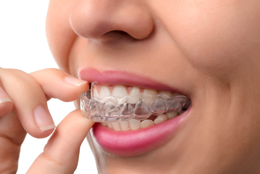 invisible aligners and Line-M-Up are helping patients