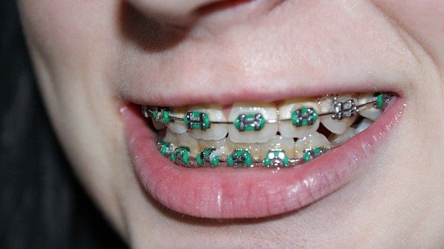 orthodontic treatment is many times in the form of metal braces for younger patients